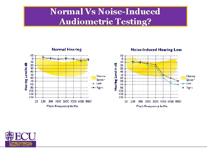 Normal Vs Noise-Induced Audiometric Testing? 