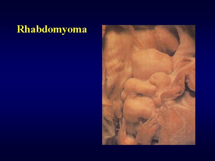 Rhabdomyoma 