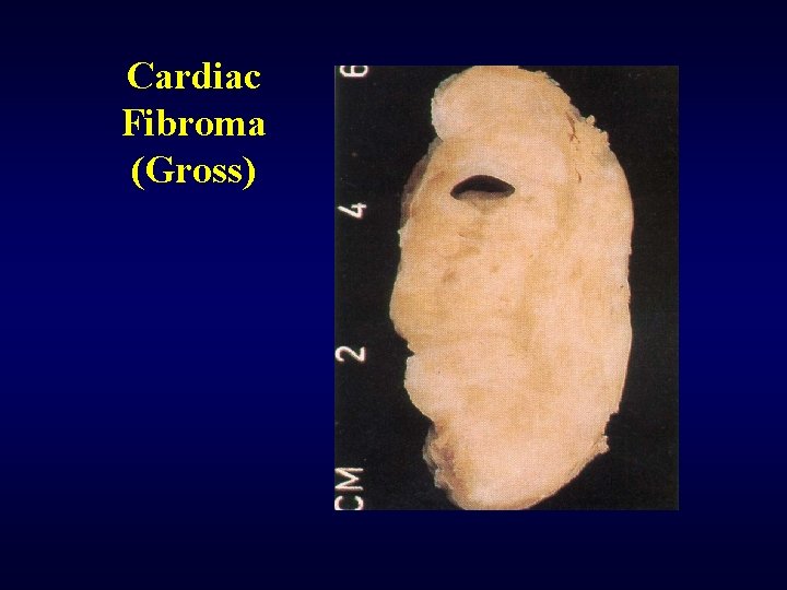 Cardiac Fibroma (Gross) 
