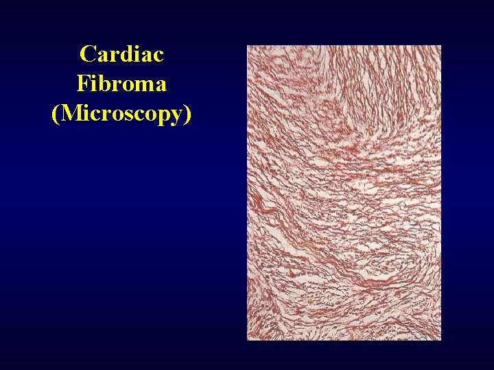Cardiac Fibroma (Microscopy) 
