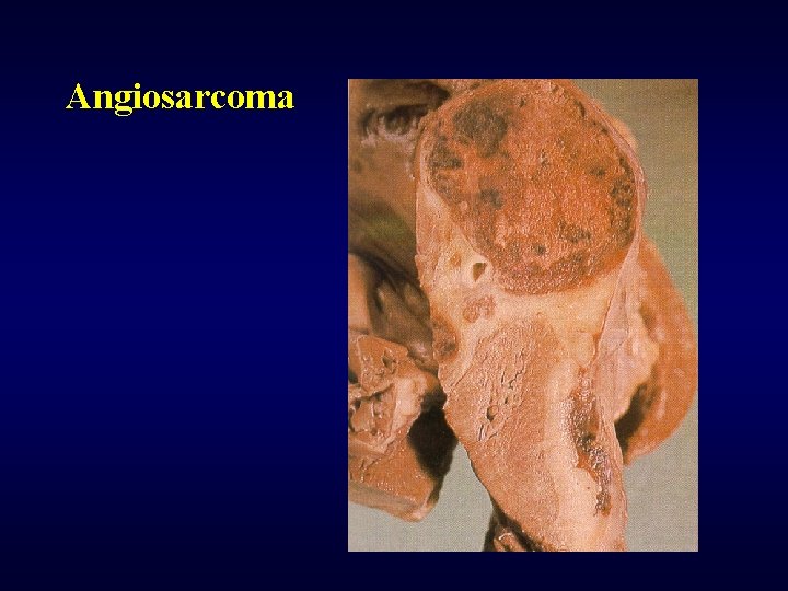 Angiosarcoma 