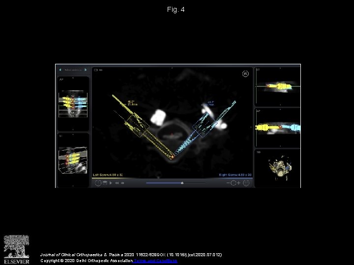 Fig. 4 Journal of Clinical Orthopaedics & Trauma 2020 11822 -829 DOI: (10. 1016/j.