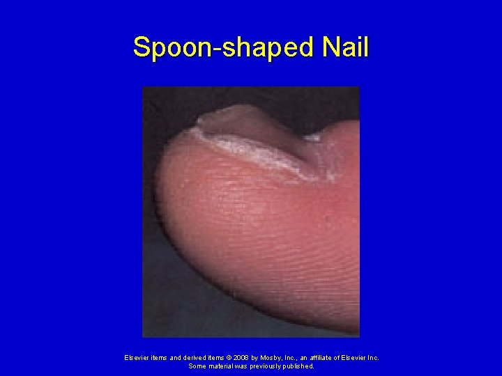 Spoon-shaped Nail Elsevier items and derived items © 2008 by Mosby, Inc. , an
