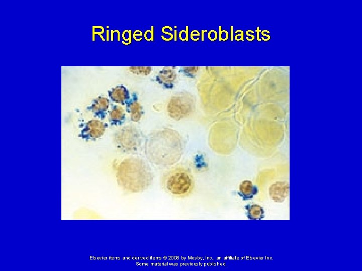 Ringed Sideroblasts Elsevier items and derived items © 2008 by Mosby, Inc. , an
