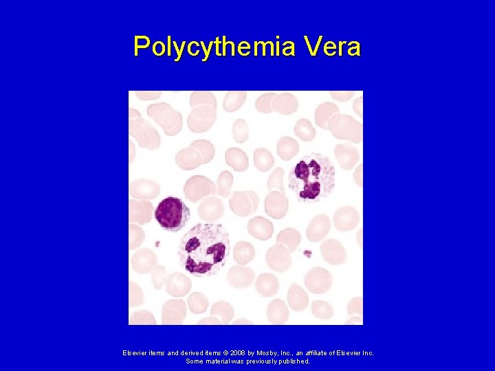 Polycythemia Vera Elsevier items and derived items © 2008 by Mosby, Inc. , an