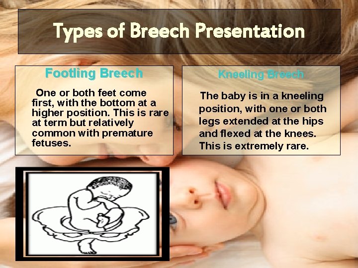 Types of Breech Presentation Footling Breech One or both feet come first, with the