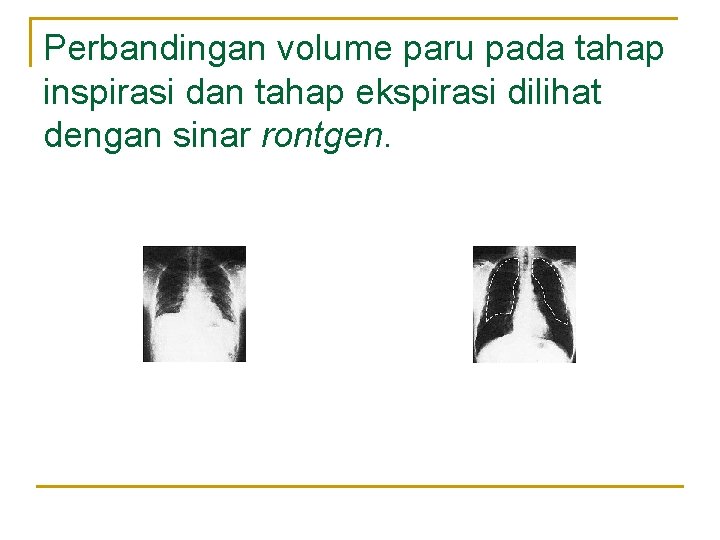 Perbandingan volume paru pada tahap inspirasi dan tahap ekspirasi dilihat dengan sinar rontgen. Perbandingan volume paru pada tahap inspirasi dan tahap ekspirasi dilihat dengan sinar rontgen.