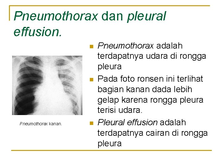 Pneumothorax dan pleural effusion. n n Pneumothorax kanan. n Pneumothorax adalah terdapatnya udara di