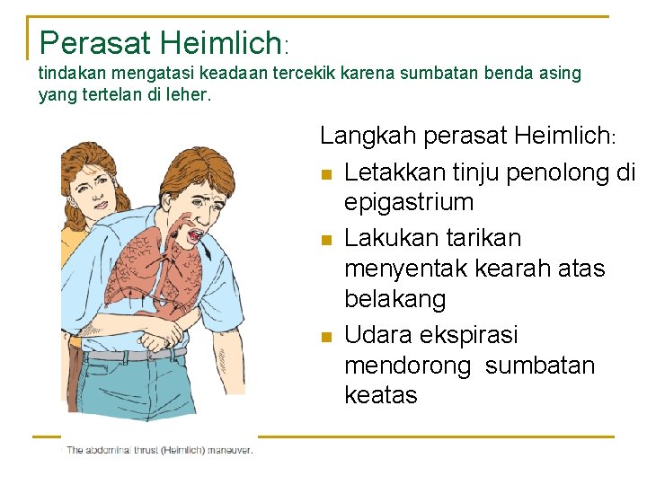 Perasat Heimlich: tindakan mengatasi keadaan tercekik karena sumbatan benda asing yang tertelan di leher.