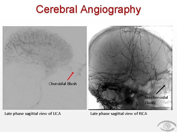 Cerebral Angiography Choroidal Blush No choroidal Blush Late phase sagittal view of LICA Late