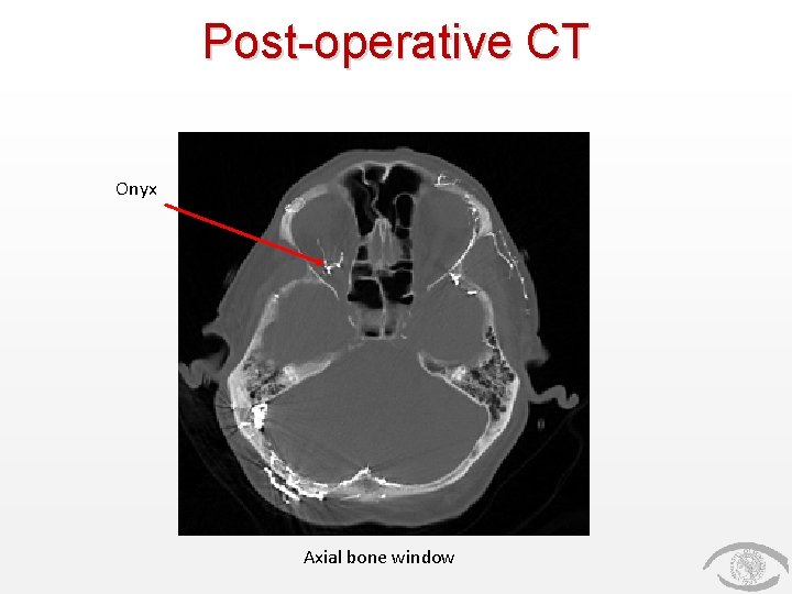Post-operative CT Onyx Axial bone window 