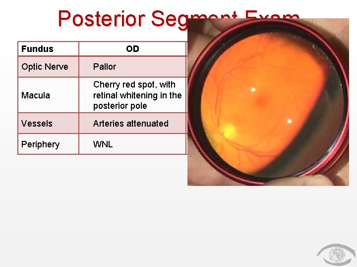 Posterior Segment Exam Fundus OD OS Optic Nerve Pallor Pink and sharp Macula Cherry
