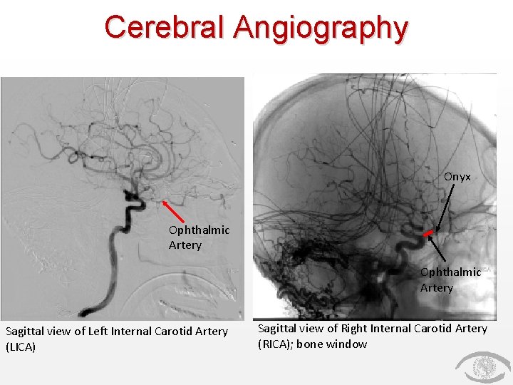 Cerebral Angiography Onyx Ophthalmic Artery Sagittal view of Left Internal Carotid Artery (LICA) Sagittal