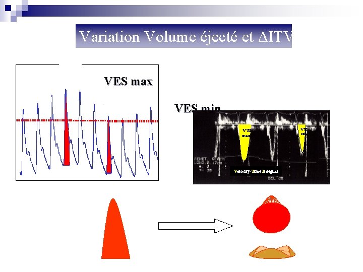 Variation Volume éjecté et ΔITV VES max VES min VTI max Velocity-Time Integral VTI