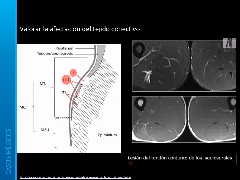 Valorar la afectación del tejido conectivo https: //www. santandermsk. com/manejo-de-las-lesiones-musculares-del-deportista/ 