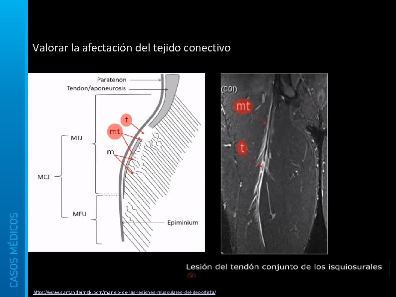 Valorar la afectación del tejido conectivo https: //www. santandermsk. com/manejo-de-las-lesiones-musculares-del-deportista/ 