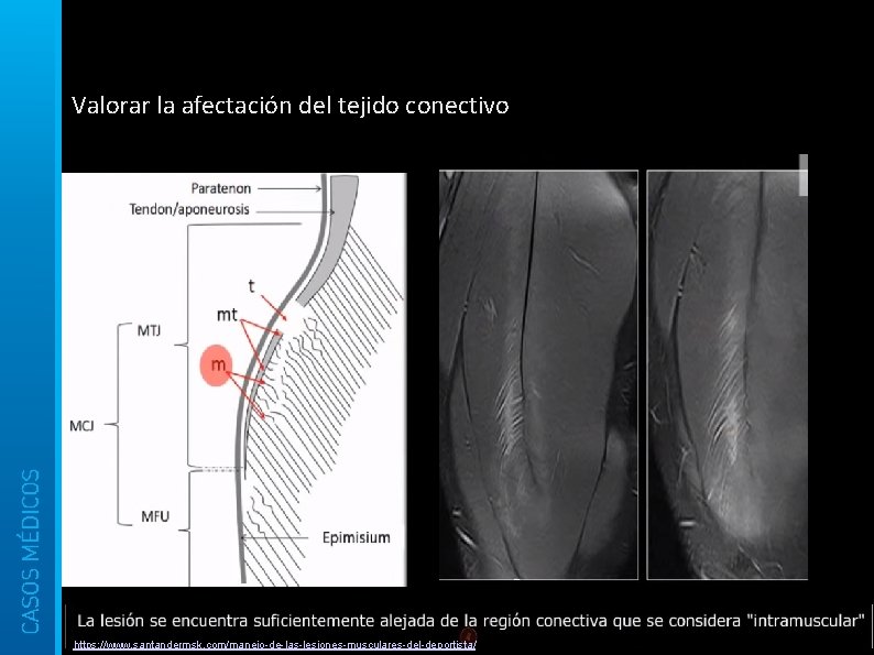 Valorar la afectación del tejido conectivo https: //www. santandermsk. com/manejo-de-las-lesiones-musculares-del-deportista/ 