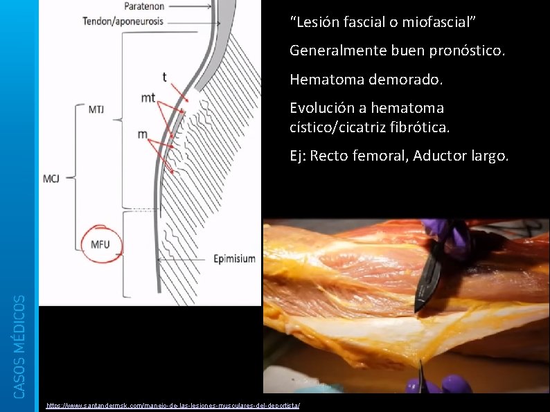  “Lesión fascial o miofascial” Generalmente buen pronóstico. Hematoma demorado. Evolución a hematoma cístico/cicatriz