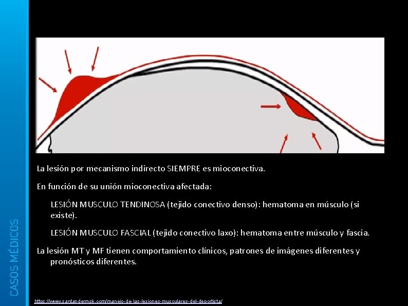 La lesión por mecanismo indirecto SIEMPRE es mioconectiva. En función de su unión mioconectiva