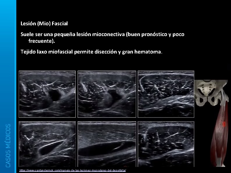 Lesión (Mio) Fascial Suele ser una pequeña lesión mioconectiva (buen pronóstico y poco frecuente).