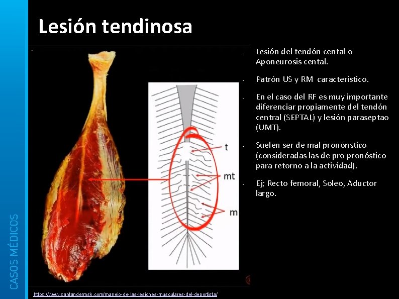 Lesión tendinosa • • • https: //www. santandermsk. com/manejo-de-las-lesiones-musculares-del-deportista/ Lesión del tendón cental o