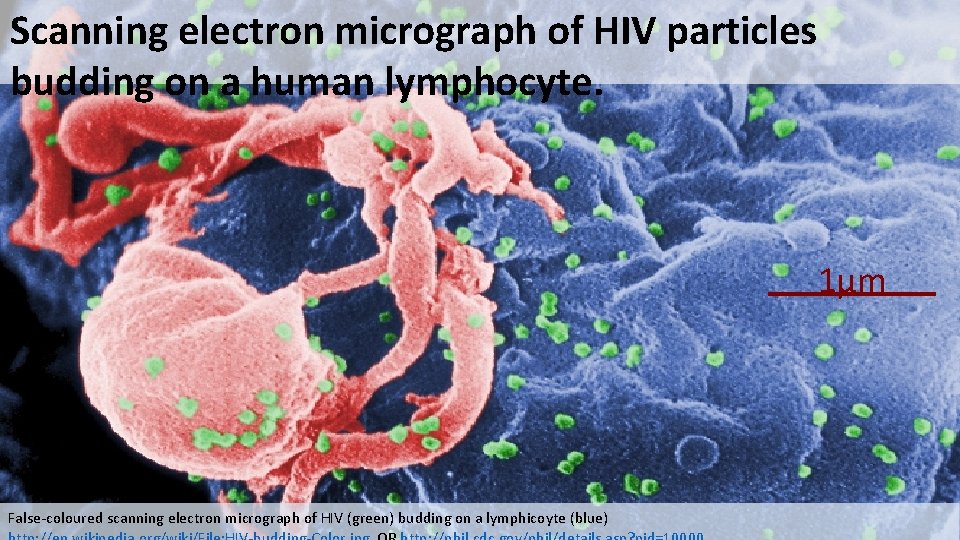 Scanning electron micrograph of HIV particles budding on a human lymphocyte. 1μm False-coloured scanning