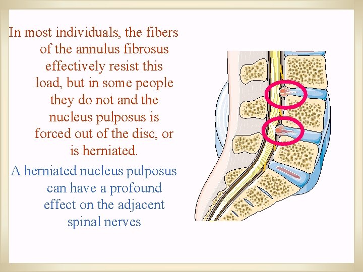 In most individuals, the fibers of the annulus fibrosus effectively resist this load, but