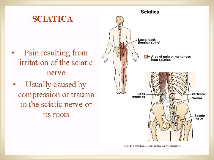 SCIATICA • Pain resulting from irritation of the sciatic nerve • Usually caused by