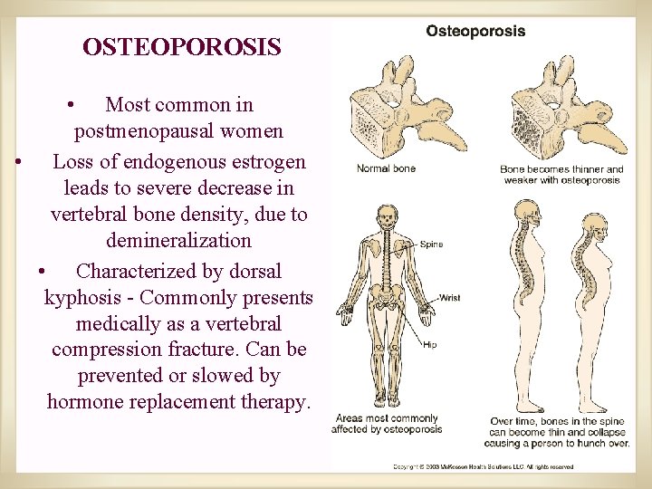 OSTEOPOROSIS • Most common in postmenopausal women • Loss of endogenous estrogen leads to