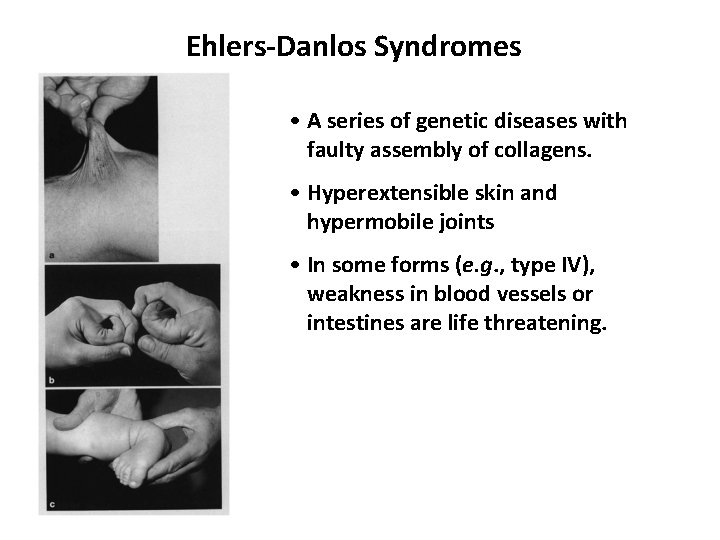 Ehlers-Danlos Syndromes • A series of genetic diseases with faulty assembly of collagens. •