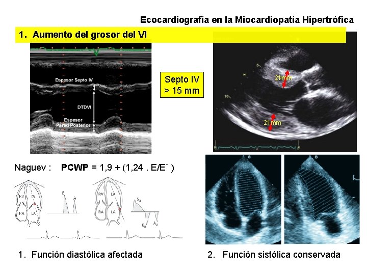 Ecocardiografía en la Miocardiopatía Hipertrófica 1. Aumento del grosor del VI Septo IV >