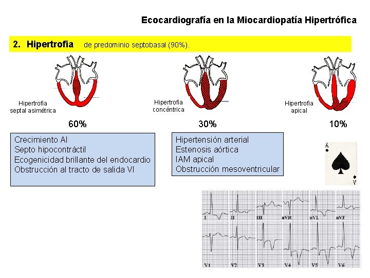 Ecocardiografía en la Miocardiopatía Hipertrófica 2. Hipertrofia de predominio septobasal (90%). Hipertrofia concéntrica Hipertrofia