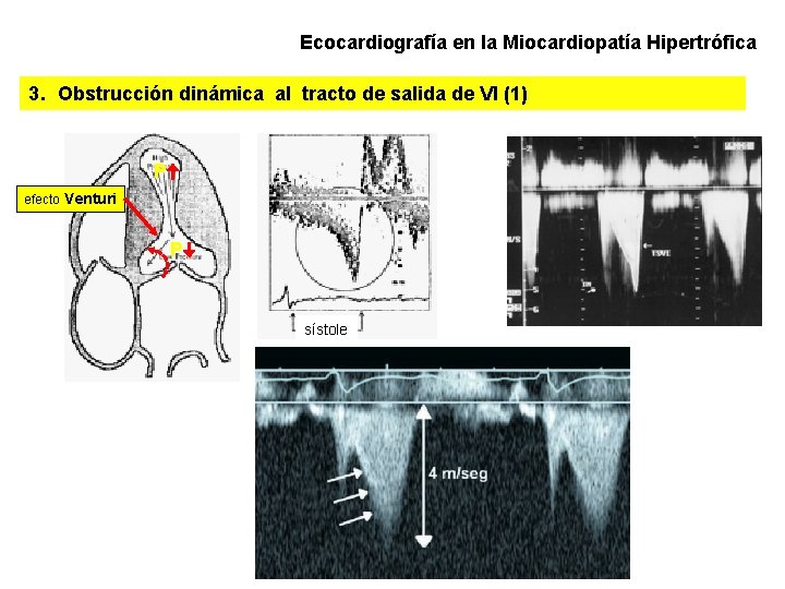 Ecocardiografía en la Miocardiopatía Hipertrófica 3. Obstrucción dinámica al tracto de salida de VI