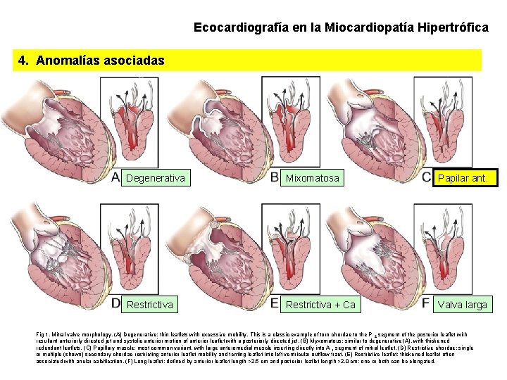 Ecocardiografía en la Miocardiopatía Hipertrófica 4. Anomalías asociadas Degenerativa Mixomatosa Papilar ant. Restrictiva +
