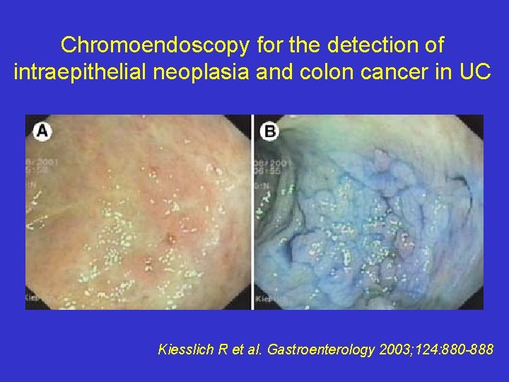 Chromoendoscopy for the detection of intraepithelial neoplasia and colon cancer in UC Kiesslich R
