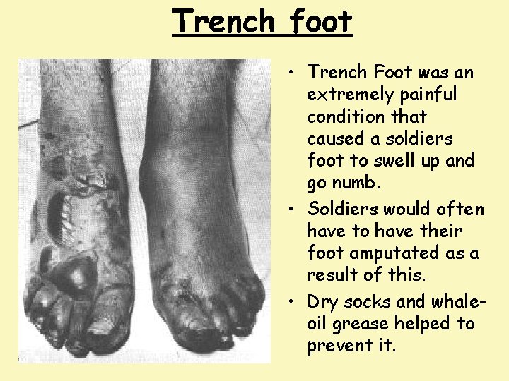 Trench foot • Trench Foot was an extremely painful condition that caused a soldiers