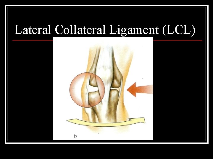 Lateral Collateral Ligament (LCL) 