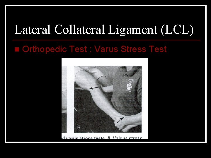 Lateral Collateral Ligament (LCL) n Orthopedic Test : Varus Stress Test 