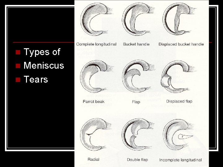 Types of n Meniscus n Tears n 