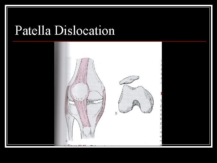 Patella Dislocation 