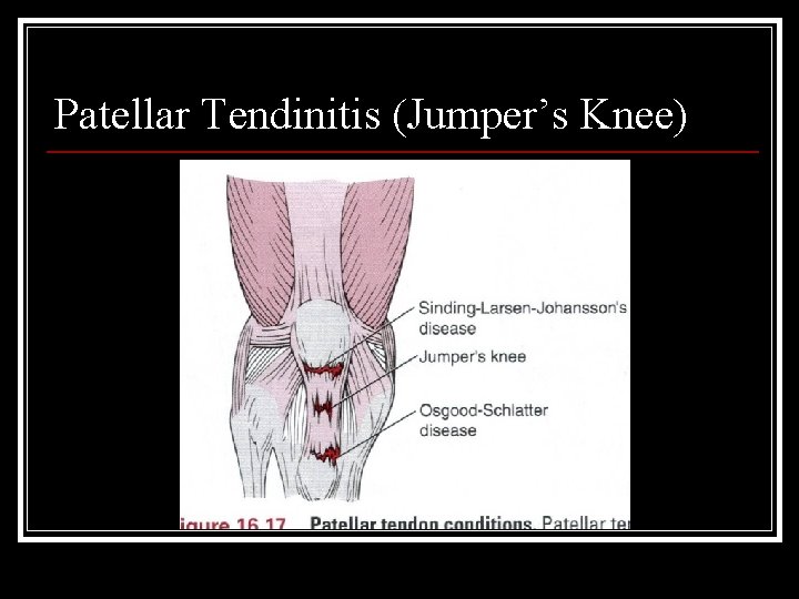 Patellar Tendinitis (Jumper’s Knee) 