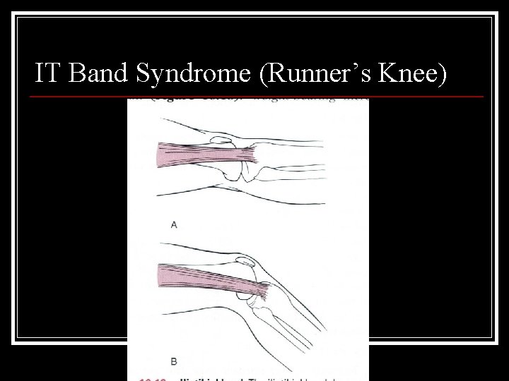 IT Band Syndrome (Runner’s Knee) 