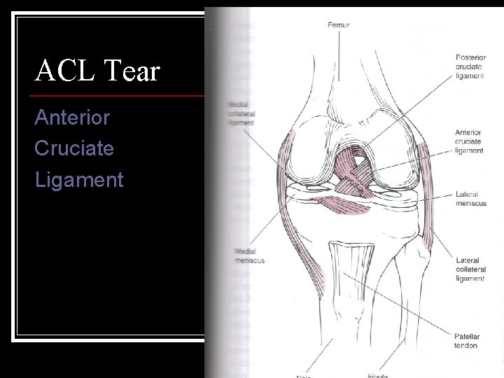 ACL Tear Anterior Cruciate Ligament 