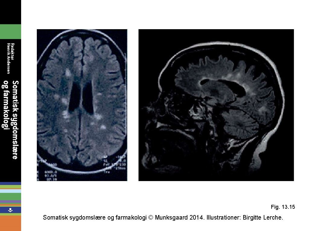 Fig. 13. 15 Somatisk sygdomslære og farmakologi © Munksgaard 2014. Illustrationer: Birgitte Lerche. 