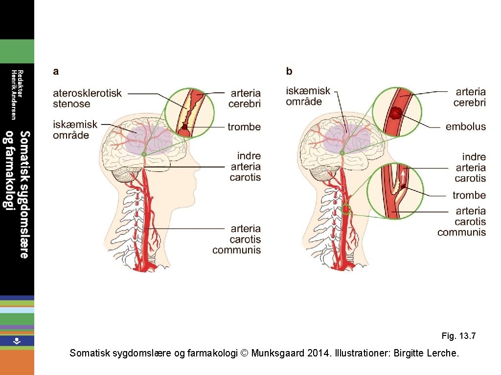 Fig. 13. 7 Somatisk sygdomslære og farmakologi © Munksgaard 2014. Illustrationer: Birgitte Lerche. 