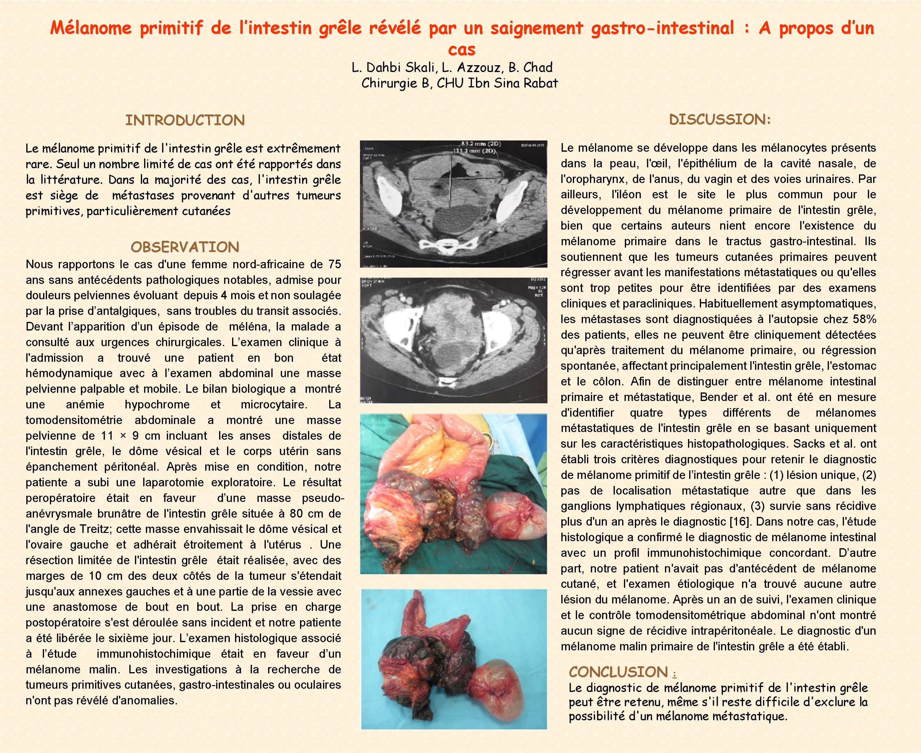 Mélanome primitif de l’intestin grêle révélé par un saignement gastro-intestinal : A propos d’un