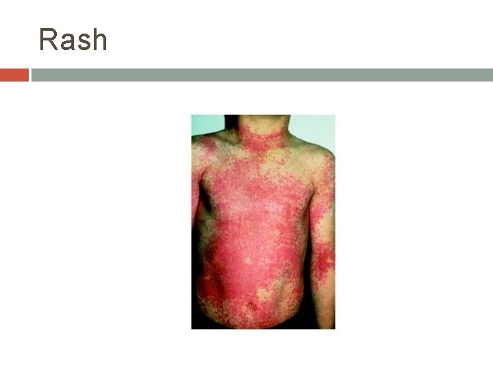 CHAPTER 4 MICROBIAL DISEASES OF THE SKIN Miss