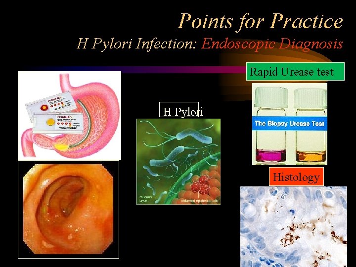 Points for Practice H Pylori Infection: Endoscopic Diagnosis Rapid Urease test H Pylori Histology