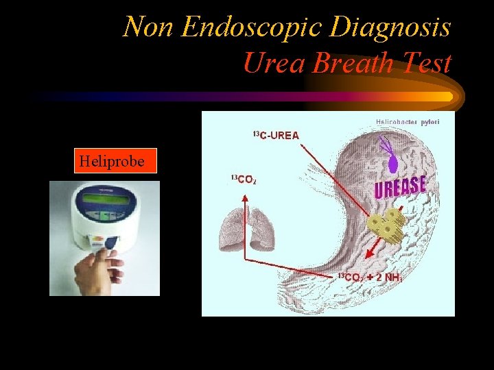 Non Endoscopic Diagnosis Urea Breath Test Heliprobe 