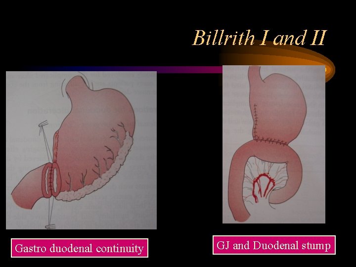 Billrith I and II Gastro duodenal continuity GJ and Duodenal stump 